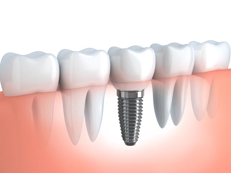 Dental Implants  Alma, AR 
